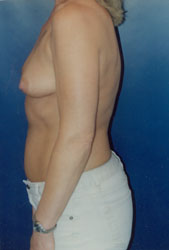 Breast Augmentation Patient 54449 Photo 3