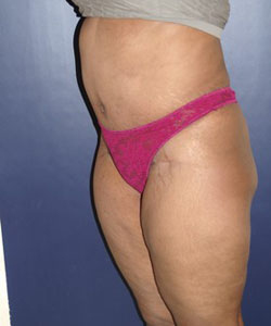 Tummy Tuck Patient 43610 Photo 2