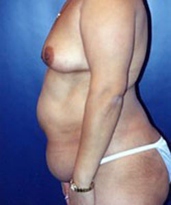 Liposculpture/Liposuction Patient 66449 Photo 3