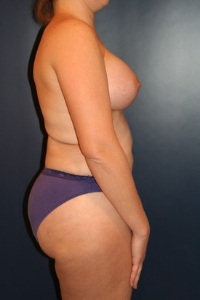 Liposculpture/Liposuction Patient 66493 Photo 2