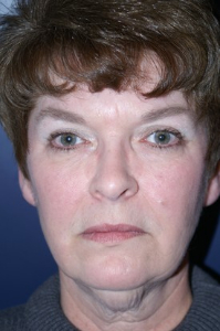 Facelift Patient 30275 Photo 3