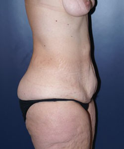 Massive Weight Loss Patient 70154 Photo 3