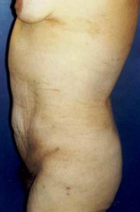 Liposculpture/Liposuction Patient 89461 Photo 2