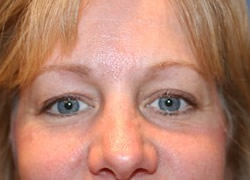 Eyelid Surgery Patient 21746 Photo 1