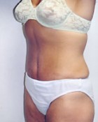 Tummy Tuck Patient 53162 Photo 2