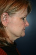 Facelift Patient 50728 Photo 1