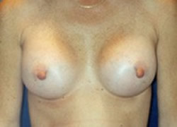 Breast Augmentation Patient 54752 Photo 2