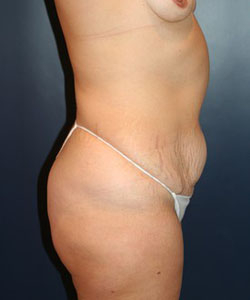 Saddle Bag Liposuction Patient 79937 Photo 3