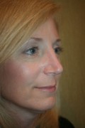 Rhinoplasty Patient 24779 Photo 2