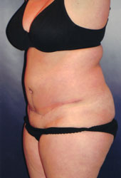 Tummy Tuck Patient 98082 Photo 6