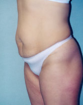 Tummy Tuck Patient 53162 Photo 1