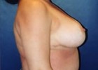 Breast Reduction Patient 55481 Photo 2