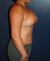 Tummy Tuck Patient 47655 Photo 2