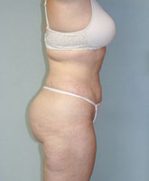 Liposculpture/Liposuction Patient 36058 Photo 2