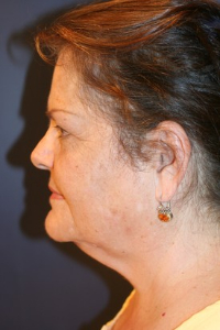 Facelift Patient 36734 Photo 1