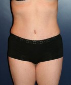 Tummy Tuck Patient 60053 Photo 2