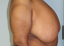 Breast Reduction Patient 54521 Photo 3