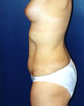 Liposculpture/Liposuction Patient 77135 Photo 2