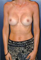 Breast Augmentation Patient 36568 Photo 2
