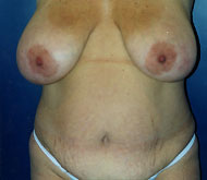 Breast Reduction Patient 23896 Photo 1