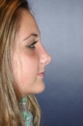 Rhinoplasty Patient 22680 Photo 2