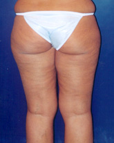 Liposculpture/Liposuction Patient 73218 Photo 5