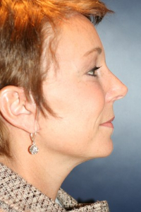 Facelift Patient 71341 Photo 2