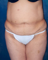 Tummy Tuck Patient 34643 Photo 1