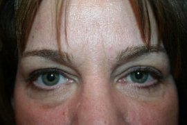 Eyelid Surgery Patient 23084 Photo 3