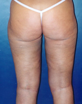 Liposculpture/Liposuction Patient 73218 Photo 6