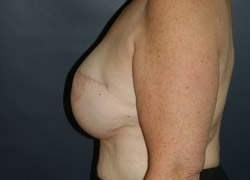 Breast Reconstruction Patient 13491 Photo 2