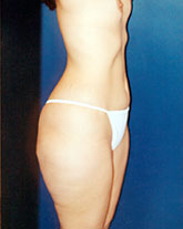 Liposculpture/Liposuction Patient 31186 Photo 5