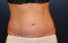 Tummy Tuck Patient 88556 Photo 2