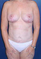 Liposuction Patient 89213 Photo 2