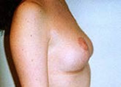 Breast Lift Patient 71861 Photo 2