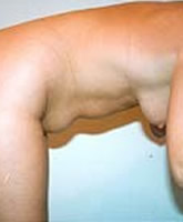 Liposculpture/Liposuction Patient 62646 Photo 1