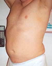 Liposculpture/Liposuction Patient 11142 Photo 2