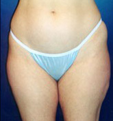 Liposculpture/Liposuction Patient 32081 Photo 1