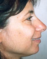 Rhinoplasty Patient 88854 Photo 1