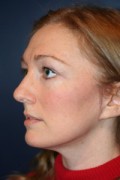 Facelift Patient 54175 Photo 2