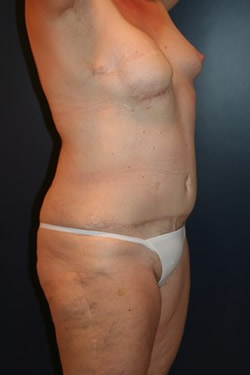 Breast Reconstruction Patient 35726 Photo 2