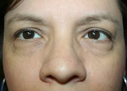 Eyelid Surgery Patient 75584 Photo 3