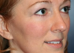 Eyelid Surgery Before & After