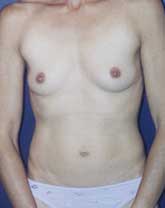 Breast Augmentation Patient 94400 Photo 5