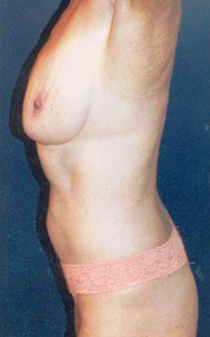 Tummy Tuck Patient 35295 Photo 5