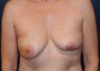 Breast Reconstruction Patient 63844 Photo 1
