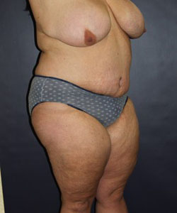 Tummy Tuck Patient 30590 Photo 2