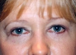 Eyelid Surgery Patient 43449 Photo 2