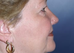 Eyelid Surgery Patient 40927 Photo 1