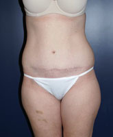 Liposculpture/Liposuction Patient 24722 Photo 3